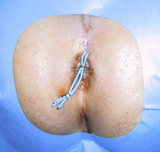 Wound Care For An Anal Fistulotomy 46